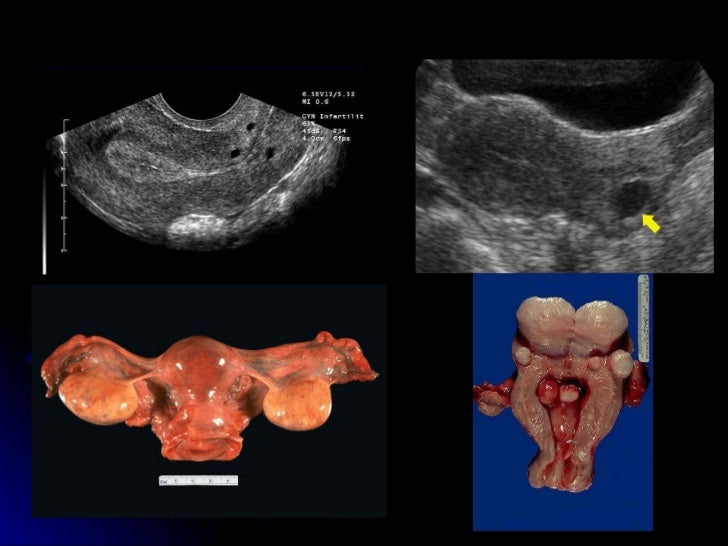 Ultrasonido pélvico