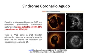 Sindrome Coronario Agudo
Estudios anatomopatológicos en SCA que
fallecieron súbitamente identificaron
ruptura de la placa culpable en 60%-65%
y erosiones en 30%-35%.
Tanto la IVUS como la OCT detectan
roturas de placa en aproximadamente la
mitad de los infartos de miocardio con
elevación del segmento ST.
JACC Cardiovasc Imaging 2022 Oct;15(10):1799-1820.
doi: 10.1016/j.jcmg.2022.04.026. Epub 2022 Sep 14
 