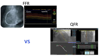 FFR
vs
QFR
 
