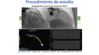 Procedimiento de estudio
Angiografía coronaria invasiva (ACI)
EuroIntervention. 2023 Jan 17;EIJ-D-21-00214. doi: 10.4244/EIJ-D-21-00214
 