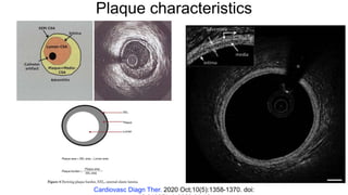 Plaque characteristics
Cardiovasc Diagn Ther. 2020 Oct;10(5):1358-1370. doi:
 