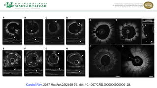 Cardiol Rev. 2017 Mar/Apr;25(2):68-76. doi: 10.1097/CRD.0000000000000128.
 