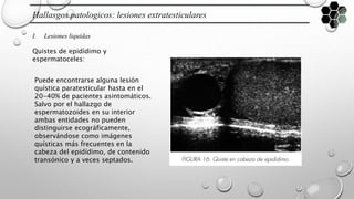 Hallasgos patologicos: lesiones extratesticulares
I. Lesiones liquidas
Quistes de epidídimo y
espermatoceles:
Puede encontrarse alguna lesión
quística paratesticular hasta en el
20-40% de pacientes asintomáticos.
Salvo por el hallazgo de
espermatozoides en su interior
ambas entidades no pueden
distinguirse ecográficamente,
observándose como imágenes
quísticas más frecuentes en la
cabeza del epidídimo, de contenido
transónico y a veces septados.
 