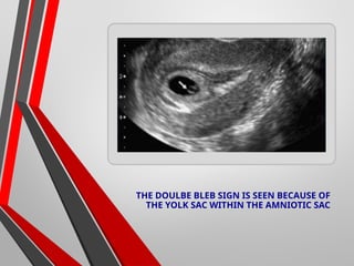 Comprehensive Ultrasonographic Evaluation of Ectopic Pregnancy ...