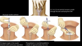 Transcricothyroid Injection Ultrasonographic identification of the cricothyroid membrane and ...