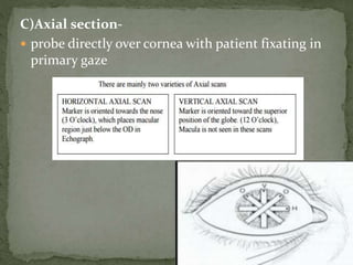 Ultrasonography in ophthalmology | PPTX