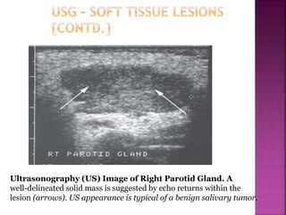 Ultrasonography (US) Image of Right Parotid Gland. A
well-delineated solid mass is suggested by echo returns within the
lesion (arrows). US appearance is typical of a benign salivary tumor.
 