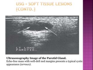 Ultrasonography Image of the Parotid Gland.
Echo-free mass with well-defi ned margins presents a typical cystic
appearance (arrows).
 