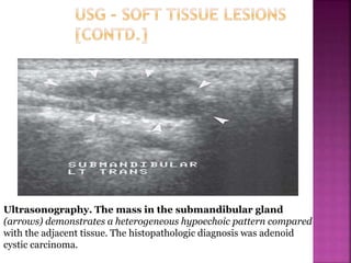 Ultrasonography. The mass in the submandibular gland
(arrows) demonstrates a heterogeneous hypoechoic pattern compared
with the adjacent tissue. The histopathologic diagnosis was adenoid
cystic carcinoma.
 