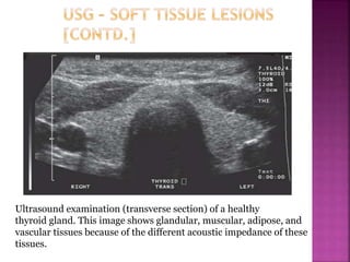 Ultrasound examination (transverse section) of a healthy
thyroid gland. This image shows glandular, muscular, adipose, and
vascular tissues because of the different acoustic impedance of these
tissues.
 