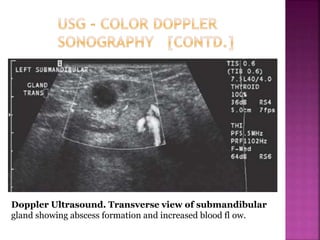 Doppler Ultrasound. Transverse view of submandibular
gland showing abscess formation and increased blood fl ow.
 