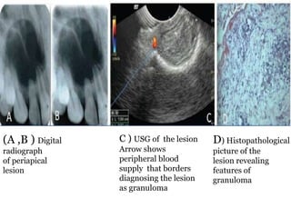 (A ,B ) Digital
radiograph
of periapical
lesion
C ) USG of the lesion
Arrow shows
peripheral blood
supply that borders
diagnosing the lesion
as granuloma
D) Histopathological
picture of the
lesion revealing
features of
granuloma
 