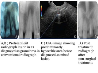 A,B ) Pretreatment
radiograph lesion in 21
diagnosed as granuloma in
conventional radiograph
C ) USG image showing
predominantly
hypoechic area hence
diagnosed as mixed
lesion
D ) Post
treatment
radiograph
after
non surgical
treatment
 