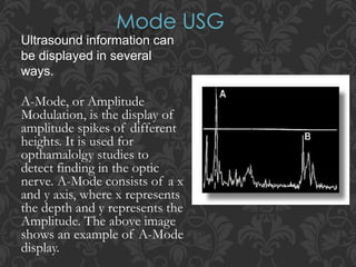 Ultrasound information can
be displayed in several
ways.
A-Mode, or Amplitude
Modulation, is the display of
amplitude spikes of different
heights. It is used for
opthamalolgy studies to
detect finding in the optic
nerve. A-Mode consists of a x
and y axis, where x represents
the depth and y represents the
Amplitude. The above image
shows an example of A-Mode
display.
 