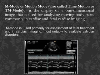 M-Mode or Motion Mode (also called Time Motion or
TM-Mode): is the display of a one-dimensional
image that is used for analyzing moving body parts
commonly in cardiac and fetal cardiac imaging.
M-mode is used primarily for assessment of fetal heartbeat
and in cardiac imaging, most notably to evaluate valvular
disorders.
 