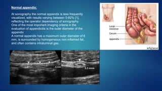 Ultrasonography in Acute Abdomen | PPTX