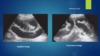 Interloop Effusions Ultrasonography in Acute Abdomen | PPTX