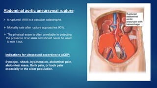 Ultrasonography in Acute Abdomen | PPTX