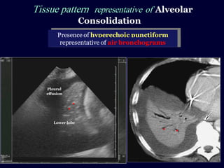 Tissue pattern representative of Alveolar
Consolidation
Presence of hyperechoic punctiform
imagesrepresentative of air bronchograms
Pleural
effusion
Lower lobe
 