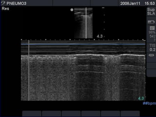 the "seashore sign" (Fig.3).
 