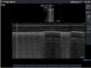 the "seashore sign" (Fig.3).
 
