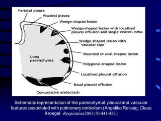 Schematic representation of the parenchymal, pleural and vascular
features associated with pulmonary embolism.(Angelika Reissig, Claus
Kroegel. Respiration2003;70:441-452)
 