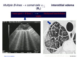 Multiple B-lines - « comet-tails » - interstitial edema
(B1)
7 mm apart « B lines » thickened interlobular
septa
D Lichtenstein et al AJRCCM 156 : 1640-1646 , 1997JJR 25 05http://www.reapitie-
http://www.reapitie- 02 09 2012
 
