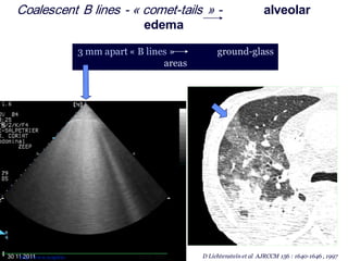 D Lichtenstein et al AJRCCM 156 : 1640-1646 , 199730 11 2011
Coalescent B lines - « comet-tails » - alveolar
edema
3 mm apart « B lines » ground-glass
areas
http://www.reapitie- 02 09 2012
 