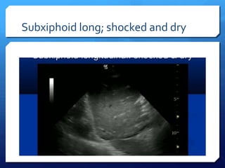 Subxiphoid long; shocked and dry
 