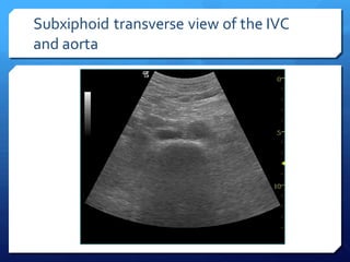 Subxiphoid transverse view of the IVC
and aorta
 