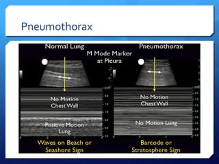 Pneumothorax
 