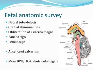 Fetal anatomic survey
 Neural tube defects
Cranial abnormalities
 Obliteration of Cisterna magna
 Banana sign
 Lemon sign
 Absence of calvarium
 More BPD/HC& Ventriculomegaly
 