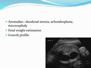  Anomalies : duodenal atresia, achondroplasia,
microcephaly
 Fetal weight estimation
 Growth profile
 