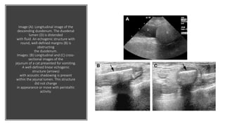 Image (A): Longitudinal image of the
descending duodenum. The duodenal
lumen (D) is distended
with fluid. An echogenic structure with
round, well-defined margins (B) is
obstructing
the duodenum.
Images: (B) Longitudinal and (C) cross-
sectional images of the
jejunum of a cat presented for vomiting.
A well-defined linear echogenic
structure (arrows)
with acoustic shadowing is present
within the jejunal lumen. This structure
did not change
in appearance or move with peristaltic
activity.
 