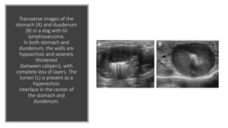 Transverse images of the
stomach (A) and duodenum
(B) in a dog with GI
lymphosarcoma.
In both stomach and
duodenum, the walls are
hypoechoic and severely
thickened
(between calipers), with
complete loss of layers. The
lumen (L) is present as a
hyperechoic
interface in the center of
the stomach and
duodenum.
 