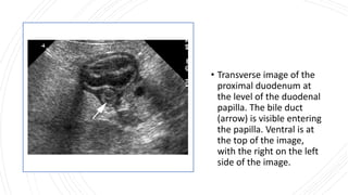 • Transverse image of the
proximal duodenum at
the level of the duodenal
papilla. The bile duct
(arrow) is visible entering
the papilla. Ventral is at
the top of the image,
with the right on the left
side of the image.
 