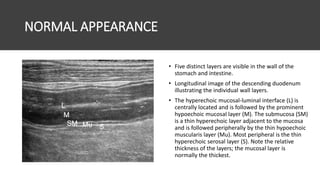 NORMAL APPEARANCE
• Five distinct layers are visible in the wall of the
stomach and intestine.
• Longitudinal image of the descending duodenum
illustrating the individual wall layers.
• The hyperechoic mucosal-luminal interface (L) is
centrally located and is followed by the prominent
hypoechoic mucosal layer (M). The submucosa (SM)
is a thin hyperechoic layer adjacent to the mucosa
and is followed peripherally by the thin hypoechoic
muscularis layer (Mu). Most peripheral is the thin
hyperechoic serosal layer (S). Note the relative
thickness of the layers; the mucosal layer is
normally the thickest.
 