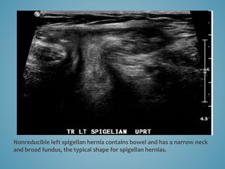 ultrasoud-hernia-pptx
