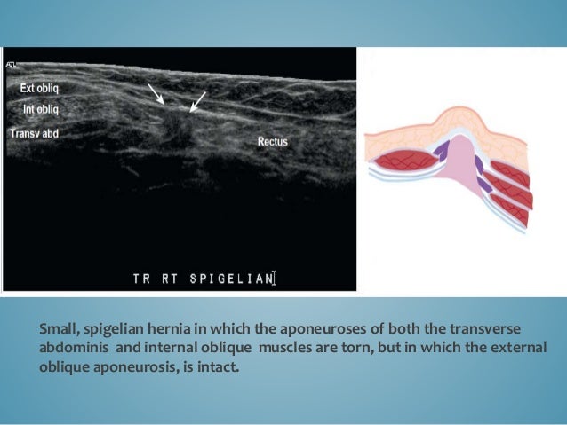 Ultrasoud hernia