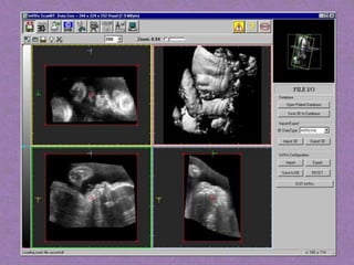 Ultrasound
