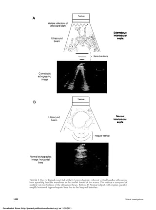 Figure 1. Top, A: Typical comet-tail artifacts: hyperechogenic, coherent vertical bundles with narrow
basis spreading from the transducer to the further border of the screen. This artifact is composed of
multiple microreflections of the ultrasound beam. Bottom, B: Normal subject, with regular, parallel,
roughly horizontal hyperechogenic lines due to the lung-wall interface.
1692 Clinical Investigations
Downloaded From: http://journal.publications.chestnet.org/ on 11/28/2013
 