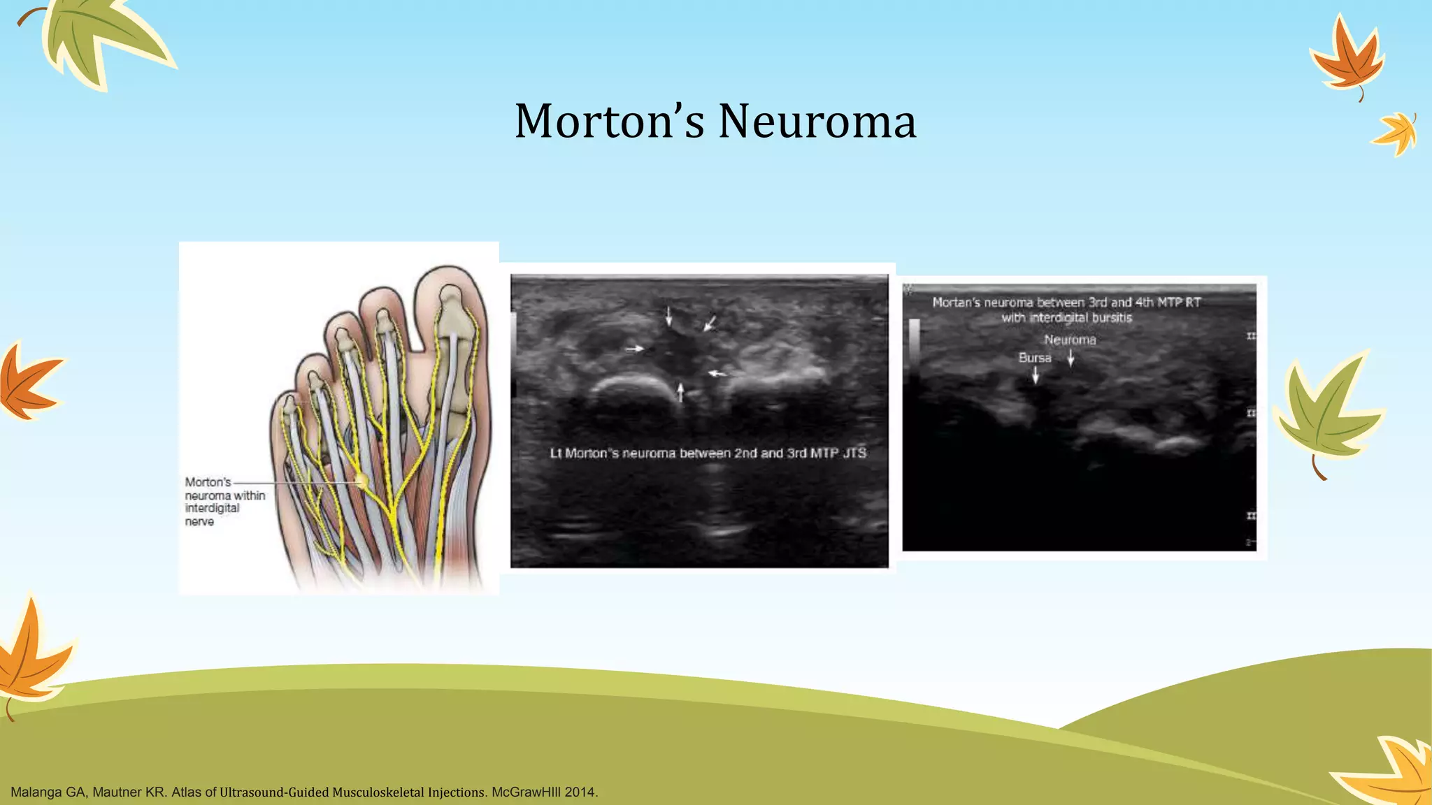 Ultrasound Guided Foot and Ankle Injections | PPT