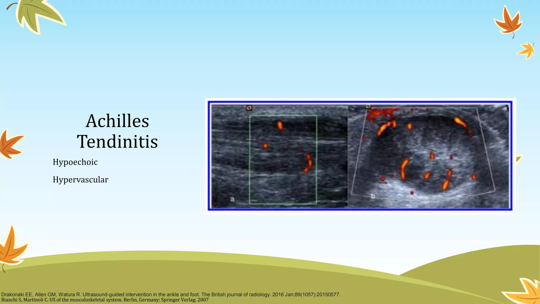 Ultrasound Guided Foot and Ankle Injections | PPT