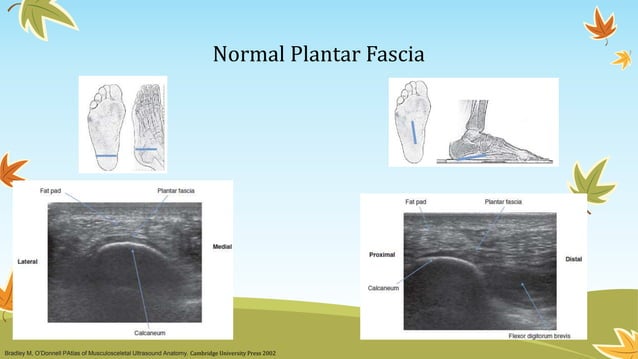 Ultrasound Guided Foot and Ankle Injections | PPT