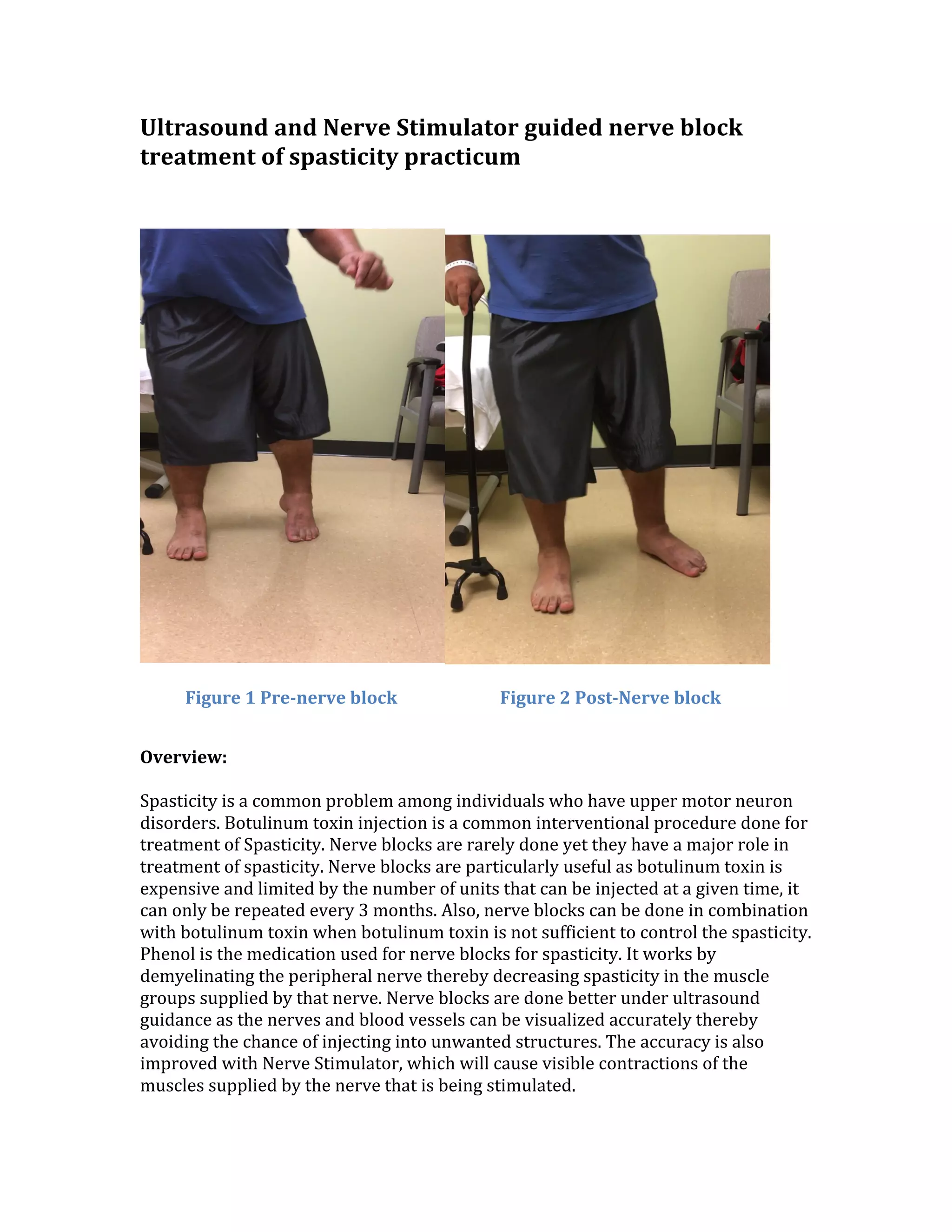 Spacicity Problem Ultrasound and nerve stimulator guided nerve block treatment of ...