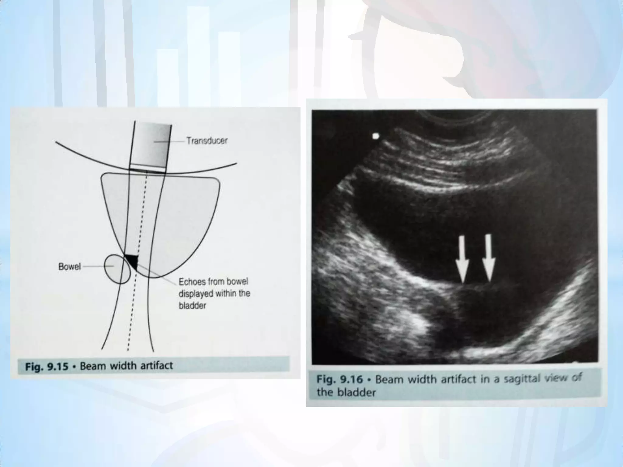 Refraction Artifact Example Ultrasound artifacts | PPTX
