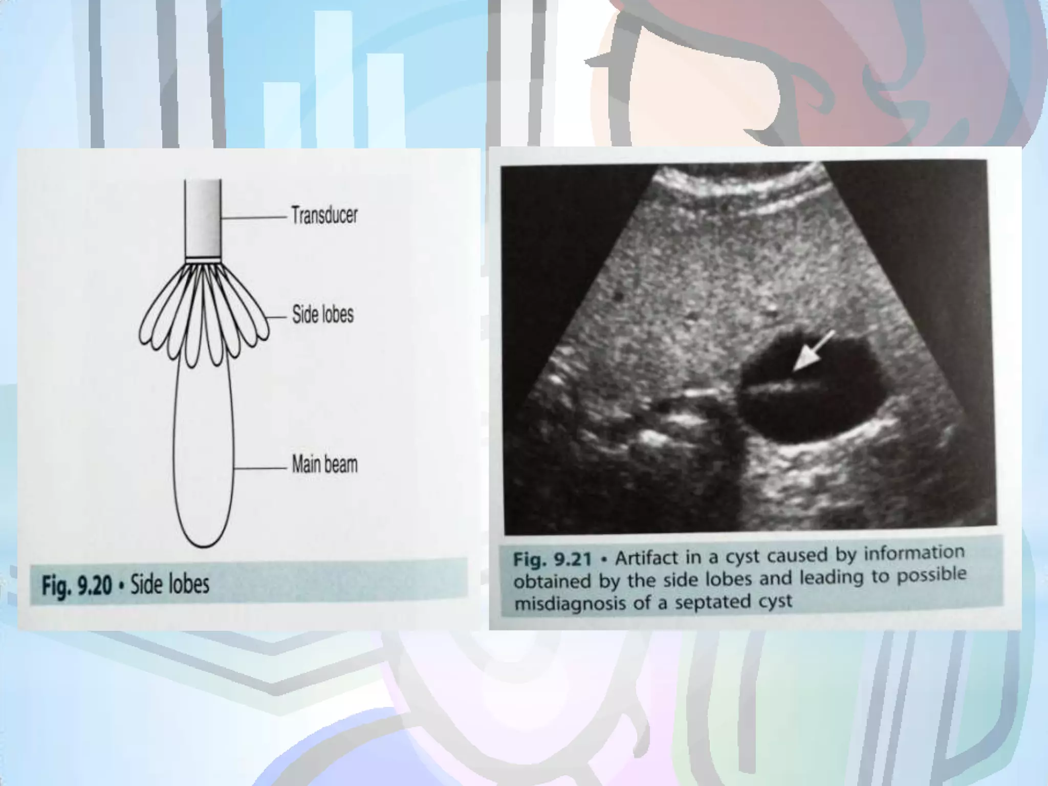 Refraction Artifact Example Ultrasound artifacts | PPTX