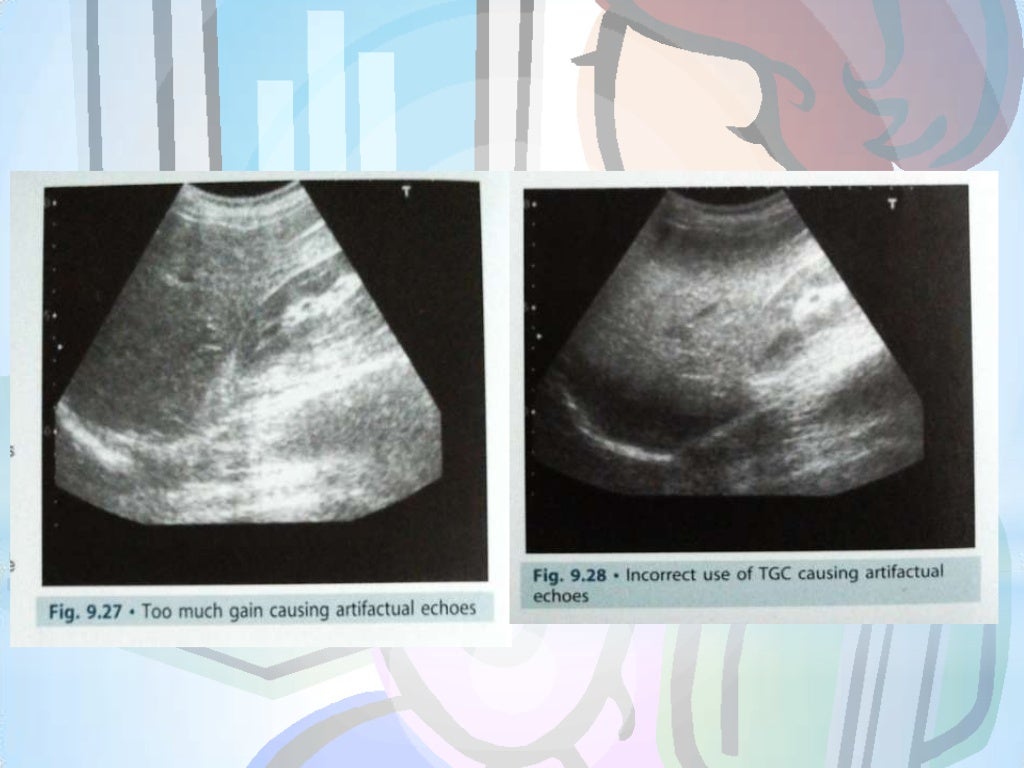 Ultrasound artifacts