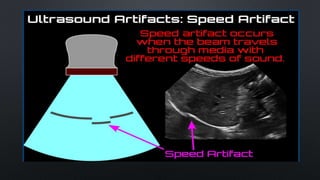 ULTRASOUND ARTIFACTS.pptx