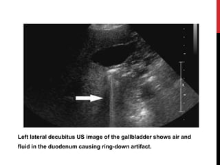 Ultrasound artifacts and contrast enhanced ultrasound | PPTX